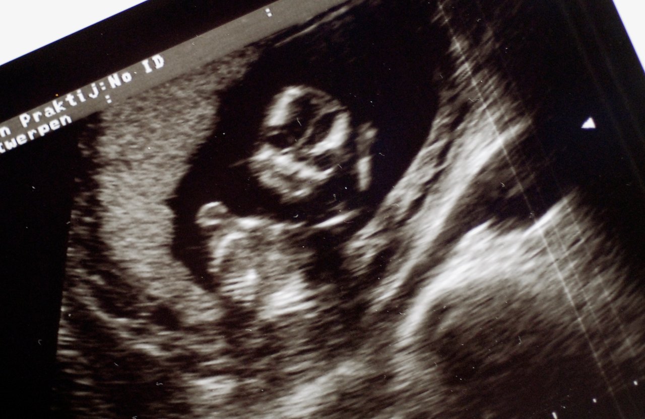 Ultrasound image showing a developing fetus inside the womb.
