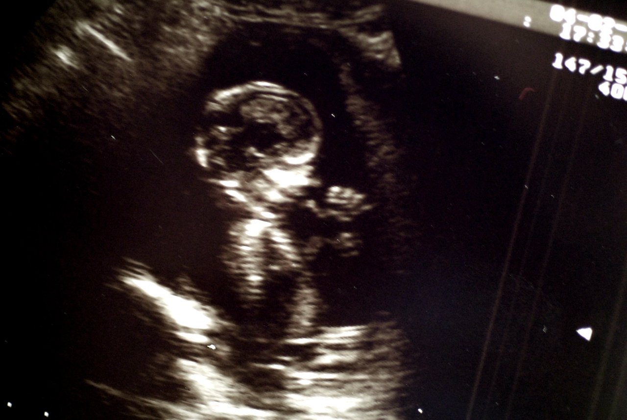 An ultrasound image showing a developing fetus in the womb.