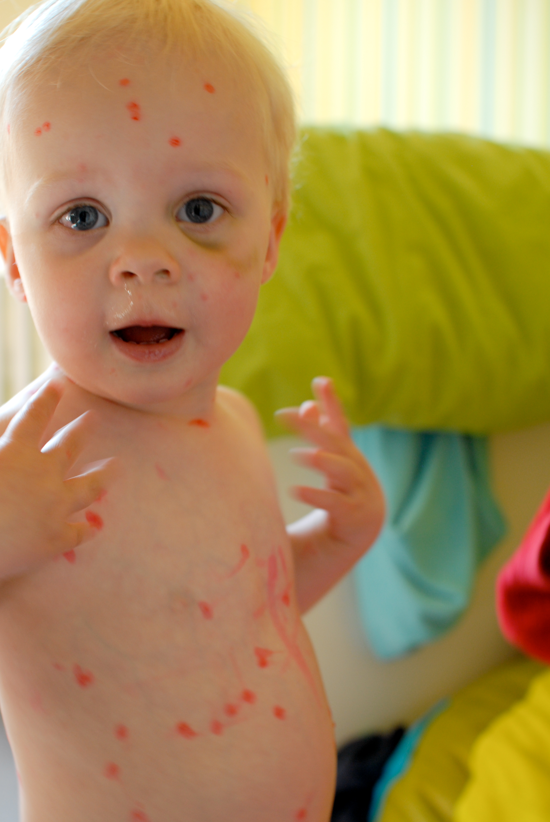 A young child with chickenpox spots on their face and body looks at the camera with an open mouth.