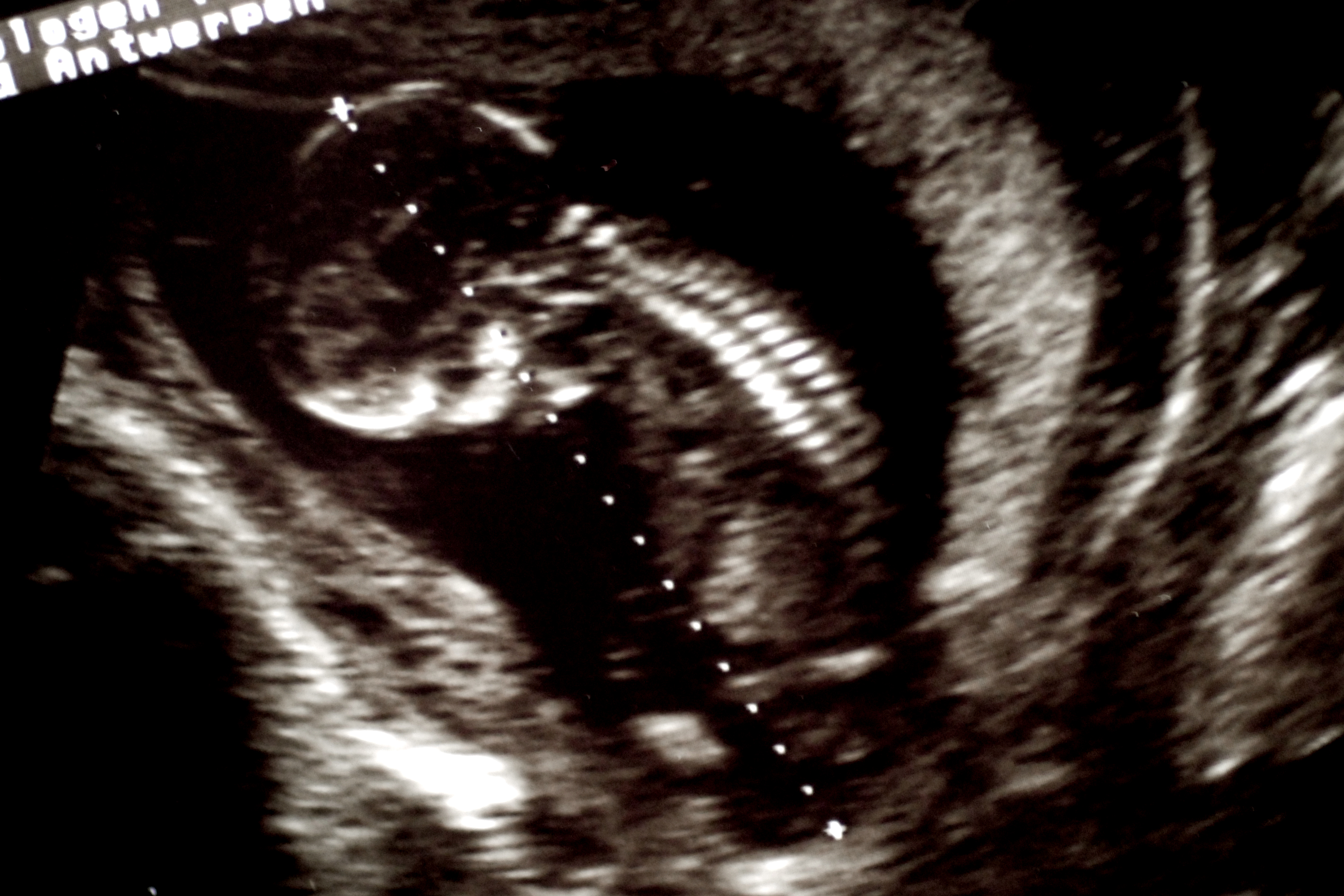 Ultrasound image showing a developing fetus with a visible spine and head.