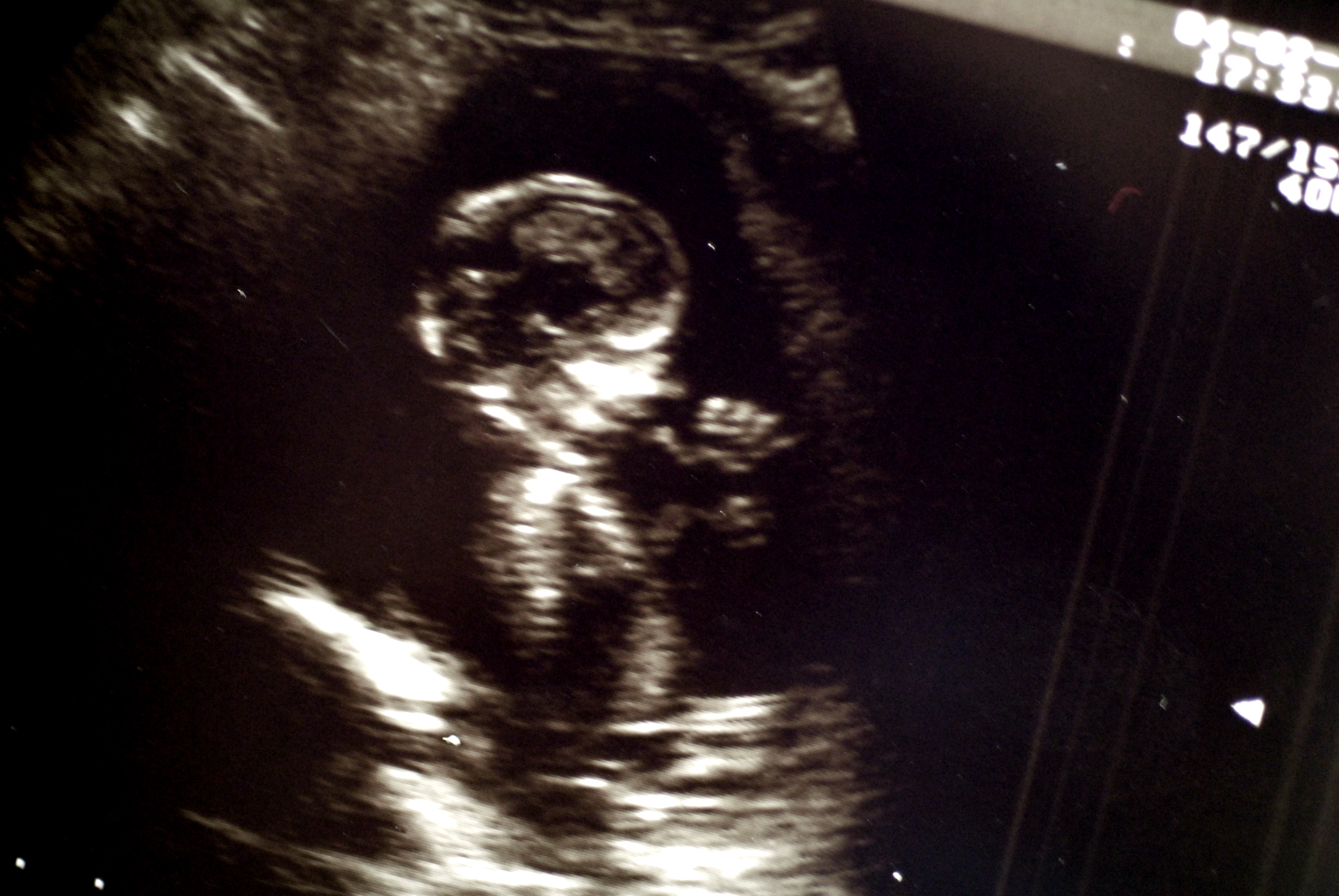 An ultrasound image showing a developing fetus in the womb.