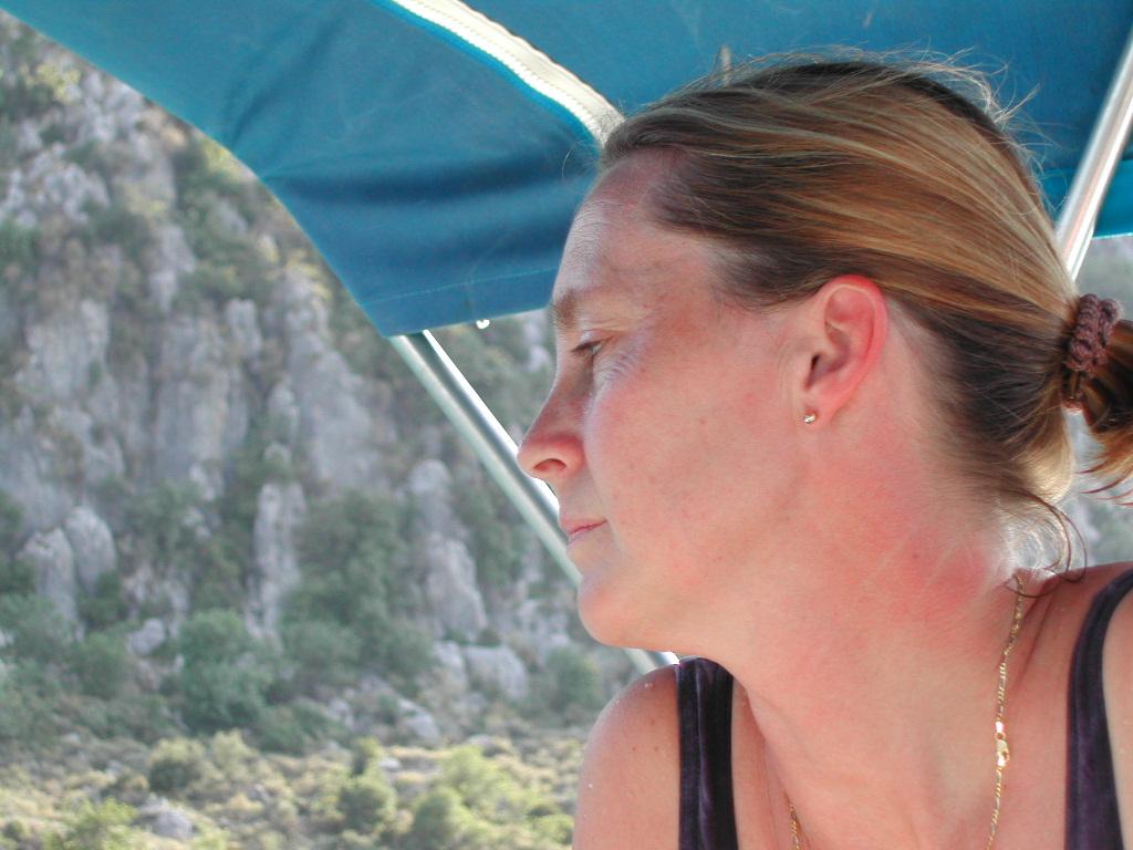 A woman with sunburned skin looks to the side while sitting under a blue canopy outdoors.